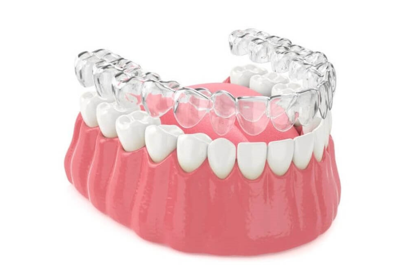 Khai niềng răng trong suốt có tác dụng gì