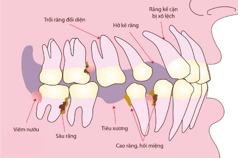 Mất răng lâu năm: Hậu quả không ngờ đến sức khỏe và giải pháp hiệu quả tại Nha Khoa 5S Tiêu xương sau khi mất răng