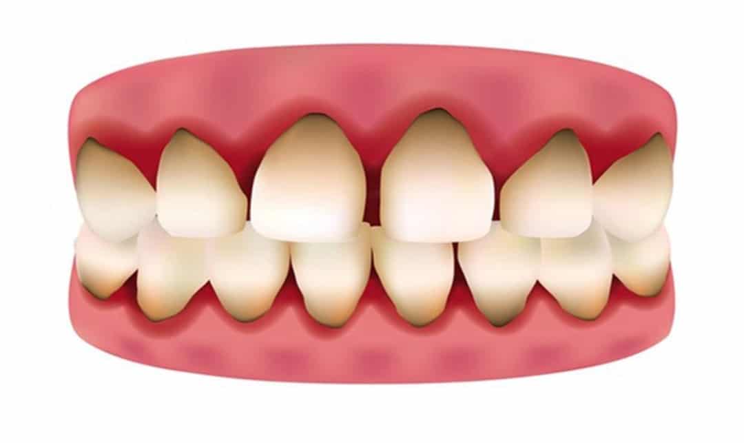 Những tác hại của việc bọc răng sứ giá rẻ Boc rang su gia re gay den vien nuou 5