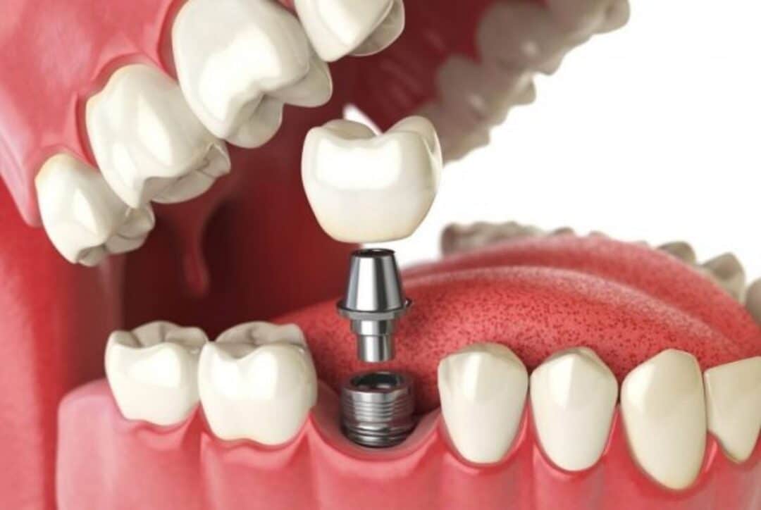 Trồng răng Implant dễ gặp phải những rủi ro nào? Cay ghep Implant la phuong phap phuc hinh rang hieu qua va tien tien 18
