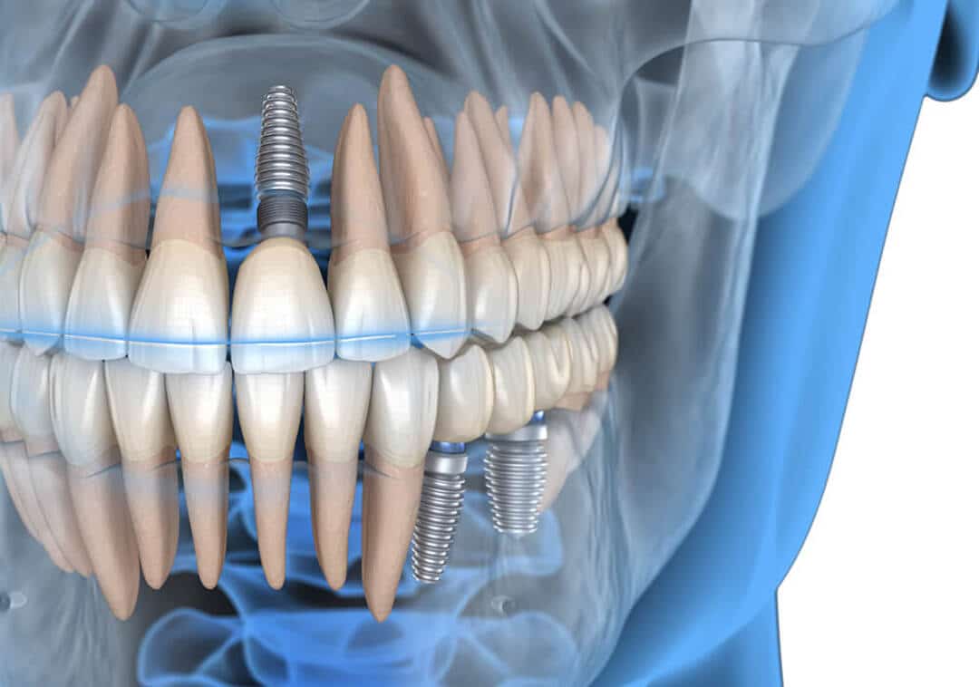 Trồng răng Implant dễ gặp phải những rủi ro nào? Khoan khong dung vi tri dan den ton thuong cac mo lan can 18