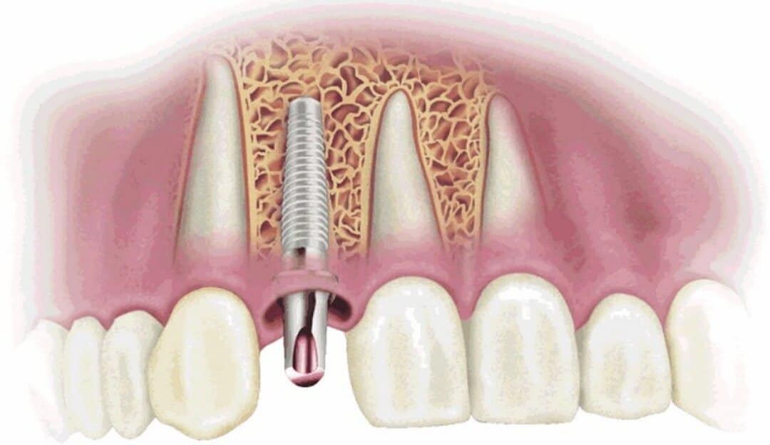 Trồng răng Implant dễ gặp phải những rủi ro nào? Rang Implant bi dao thai 18