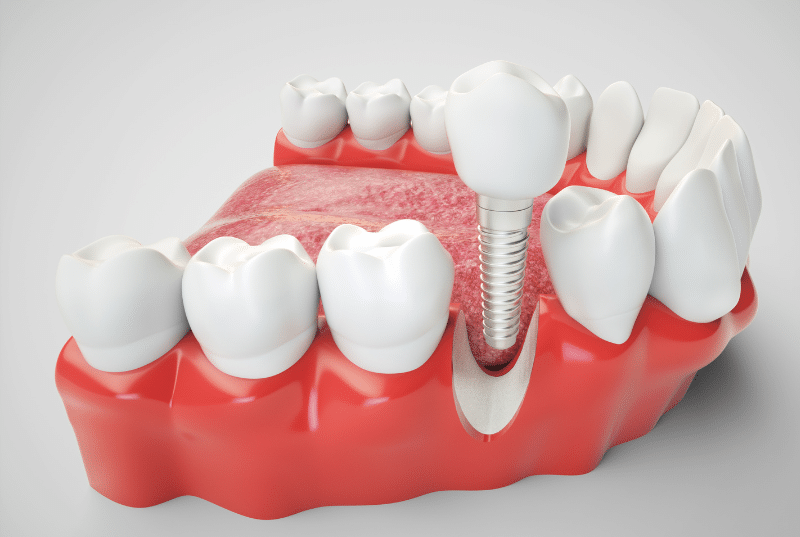 trong rang implant