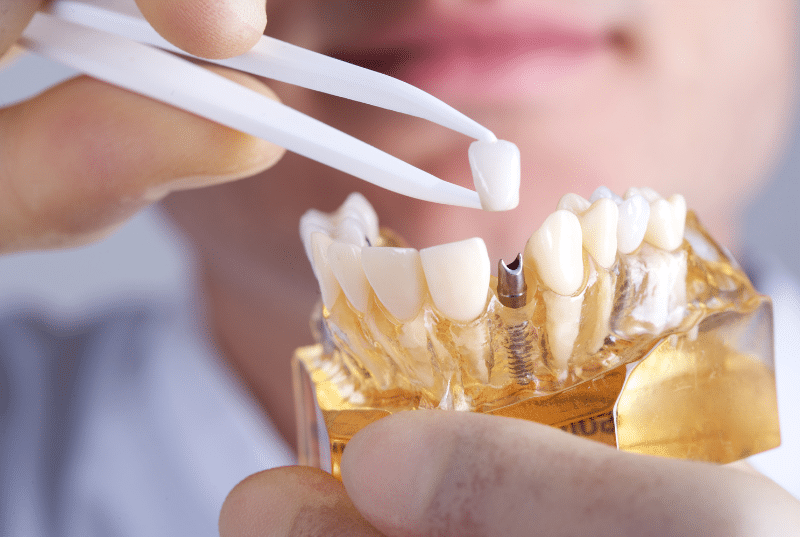 cay ghep implant