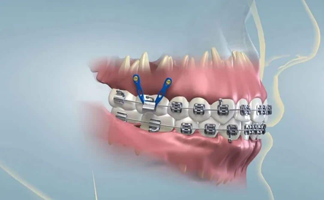Đâu là giai đoạn xấu nhất khi niềng răng? cac giai doan thay doi sau khi nieng rang 5