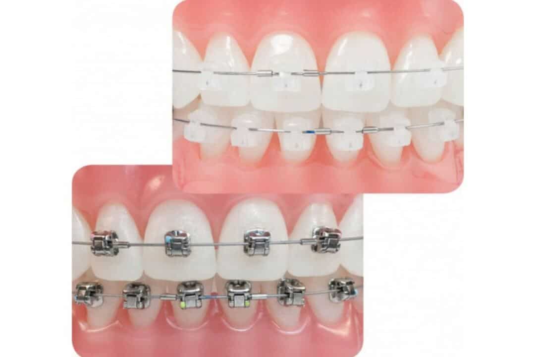 Ưu, nhược điểm của các loại mắc cài niềng răng cac loai mac cao nieng rang 5