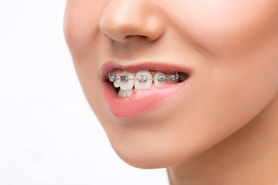 Quá trình niềng răng diễn ra như thế nào? doi tuong nen nieng rang 5