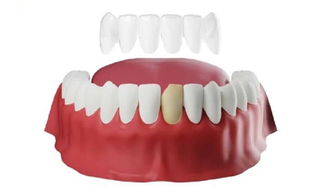 Những hậu quả của việc bọc răng sứ không an toàn gay hong rang goc 1 5