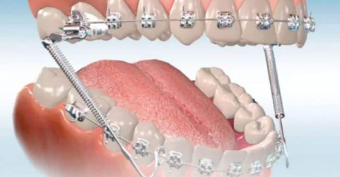 Đâu là giai đoạn xấu nhất khi niềng răng? giai doan gan mac cai 5