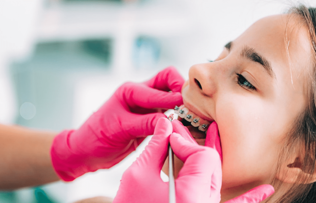 Đâu là giai đoạn xấu nhất khi niềng răng? giai doan siet chat day cung 5