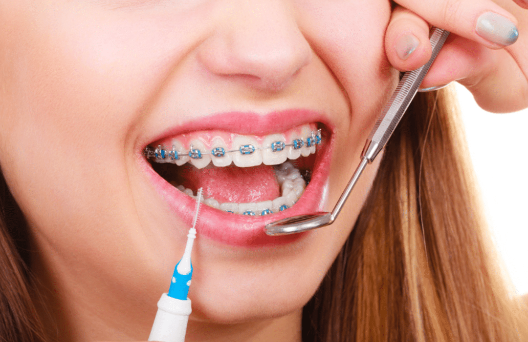 Quá trình niềng răng diễn ra như thế nào? luu y khi nieng rang 5