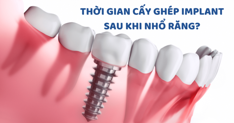 trong rang implant