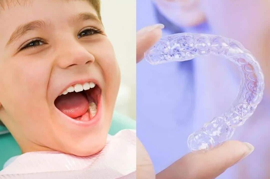 Quá trình niềng răng diễn ra như thế nào? nieng rang cho tre 5