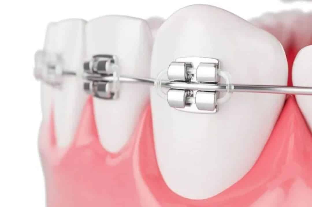 Đâu là giai đoạn xấu nhất khi niềng răng? nieng rang hoat dong nhu the nao 5