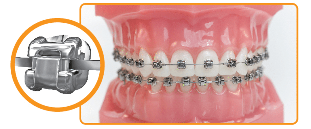 Quá trình niềng răng diễn ra như thế nào? nieng rang mac cai 5