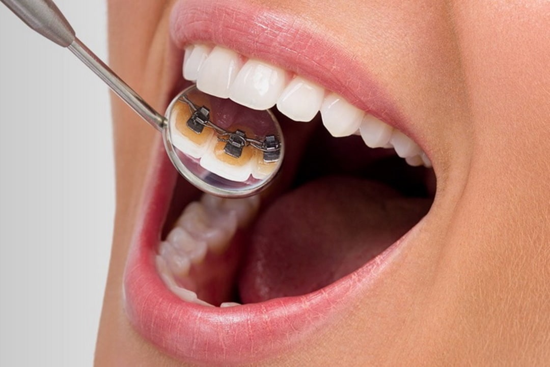 nieng rang mat trong 5