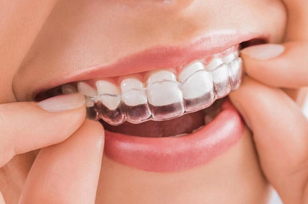 Quá trình niềng răng diễn ra như thế nào? nieng rang vo hinh invisalign 5