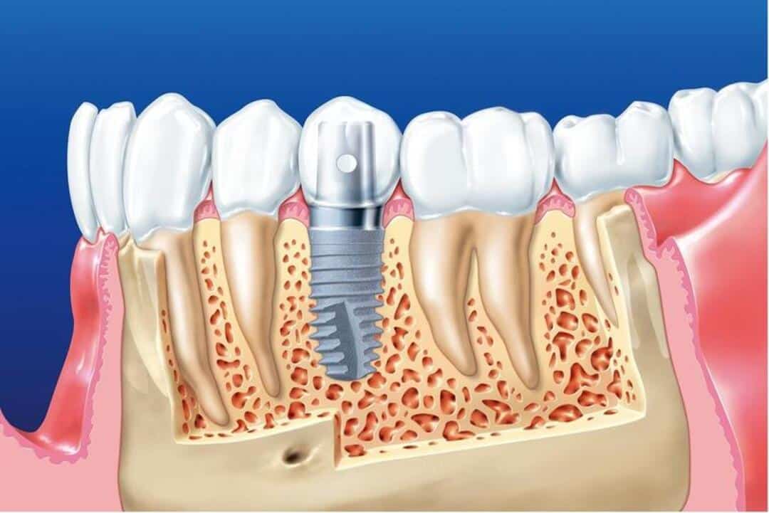 rang implant bi lung lay 17