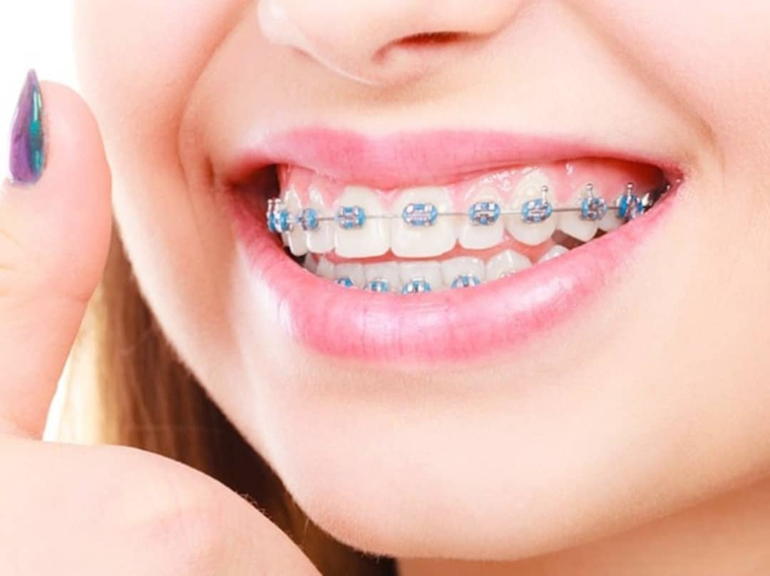 Quá trình niềng răng diễn ra như thế nào? tai sao nen nieng rang 5