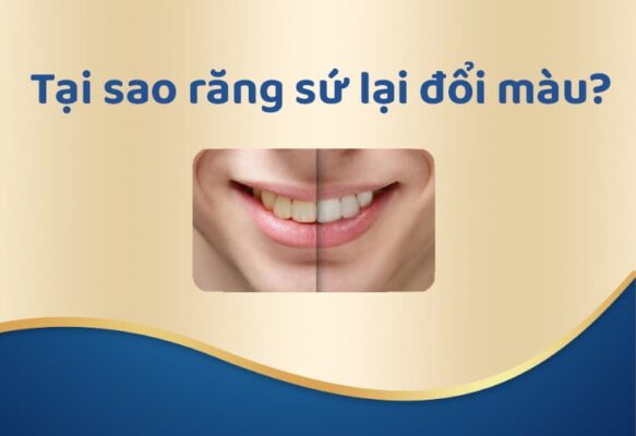 tai sao rang su lai doi mau 5