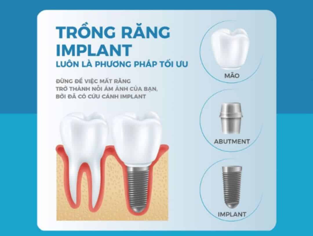 trong rang implant 5