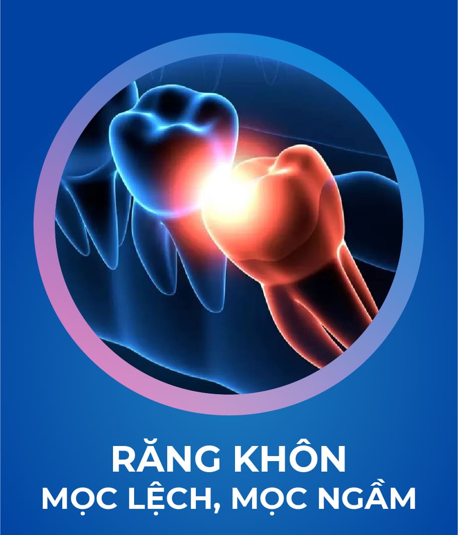 Dịch vụ Nhổ răng khôn 328 x 383