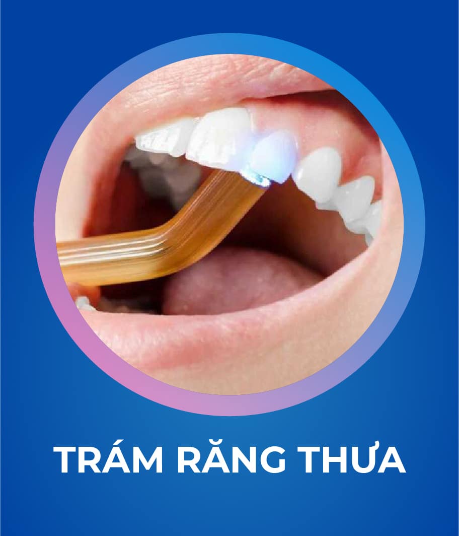 Dịch vụ Trám răng 328 x 383
