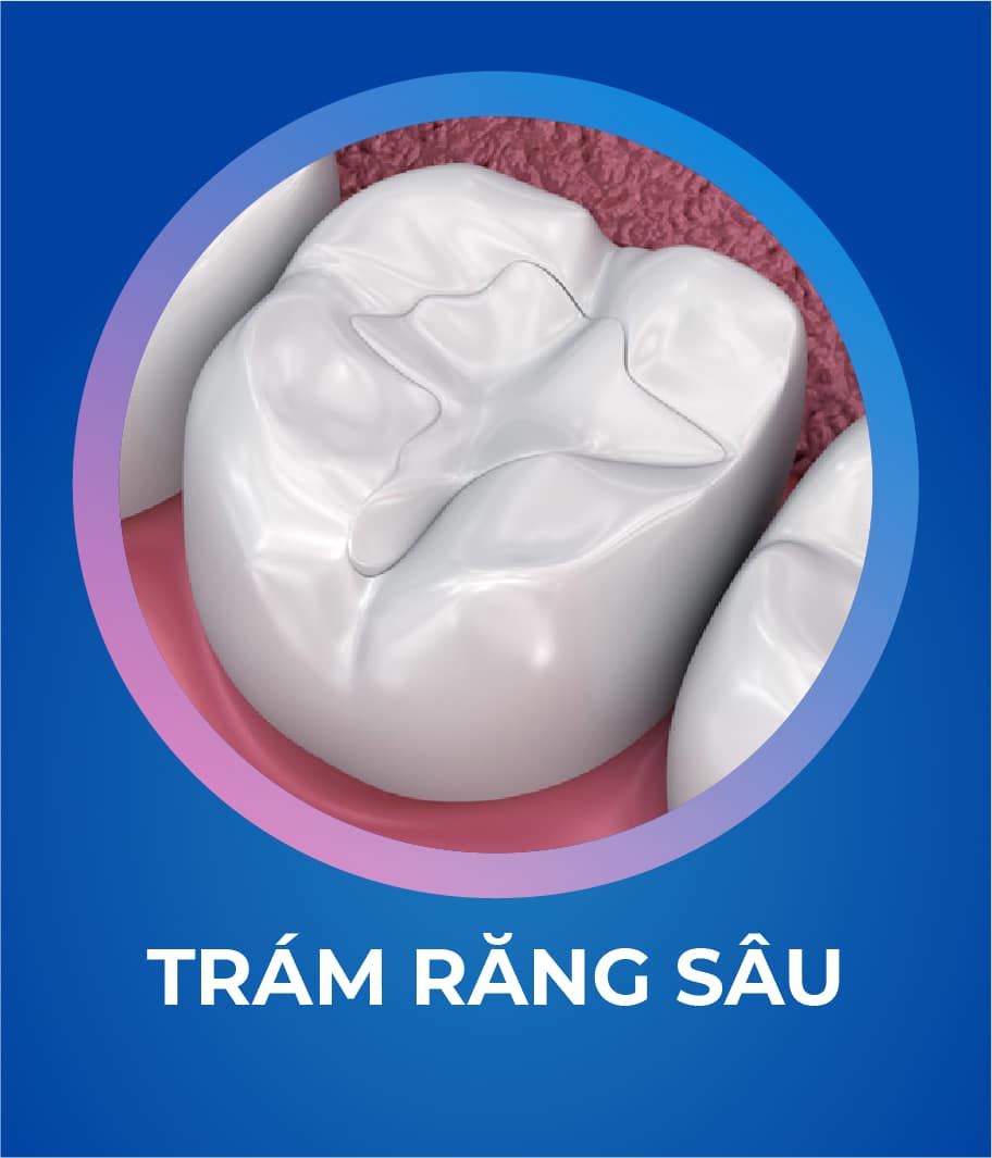 Dịch vụ Trám răng 328 x 383_2