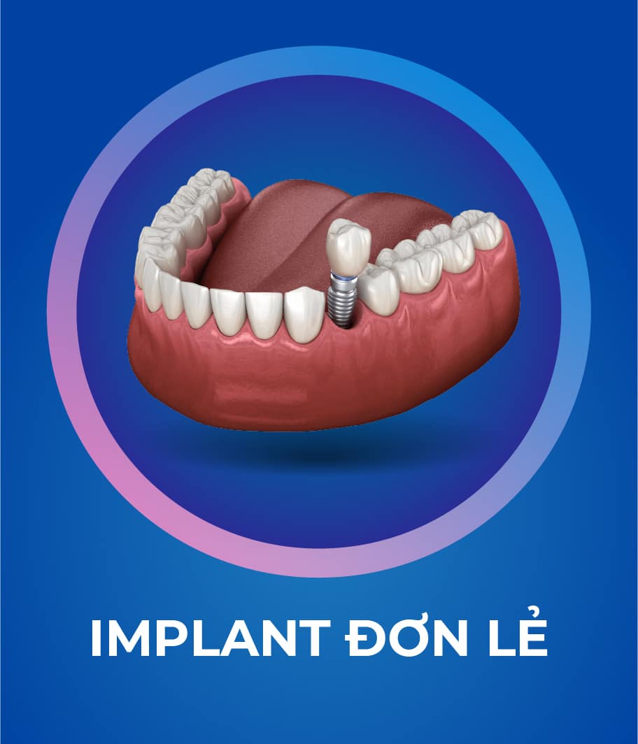 Dịch vụ Trồng răng Implant 328 x 383 px