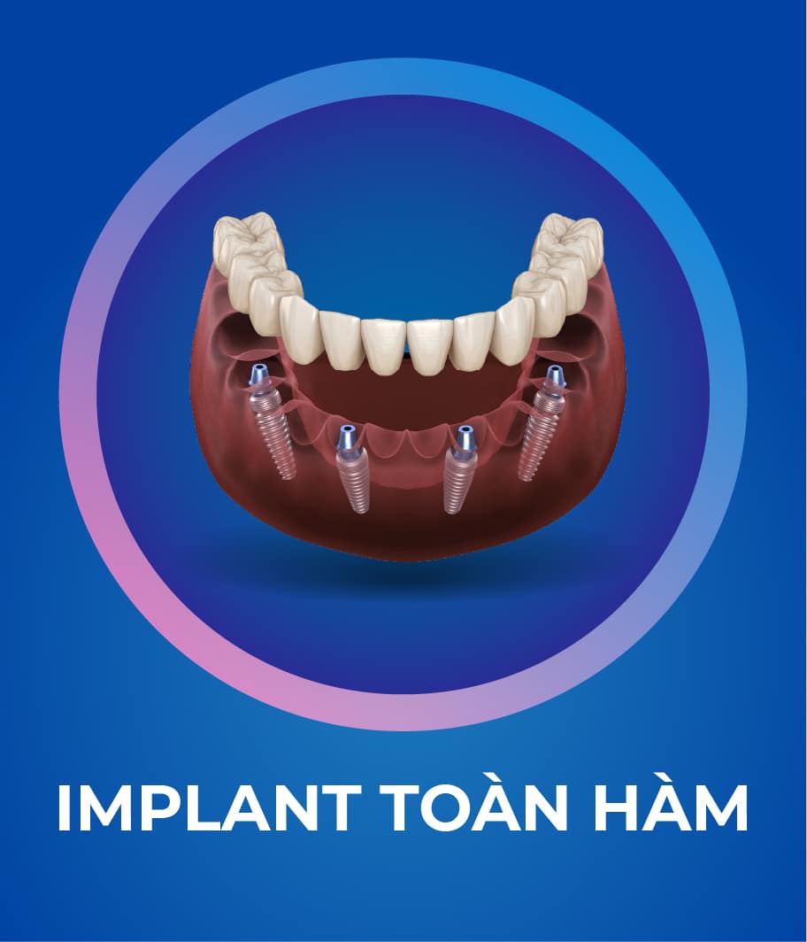 Dịch vụ Trồng răng Implant 328 x 383 px_1