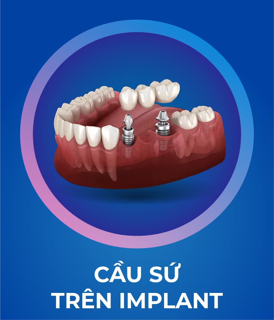 Dịch vụ Trồng răng Implant 328 x 383 px_2