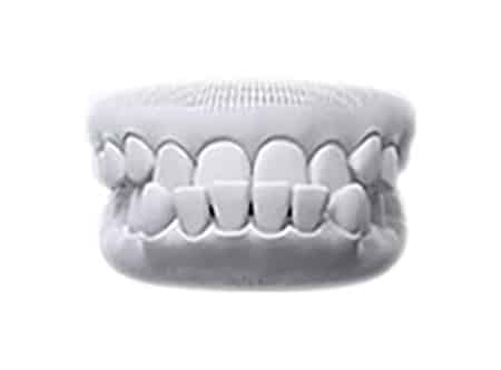 Răng cắn ngược (móm)