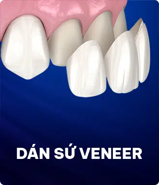 Dán Sứ Veneer