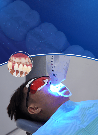 banner tẩy trắng răng mb