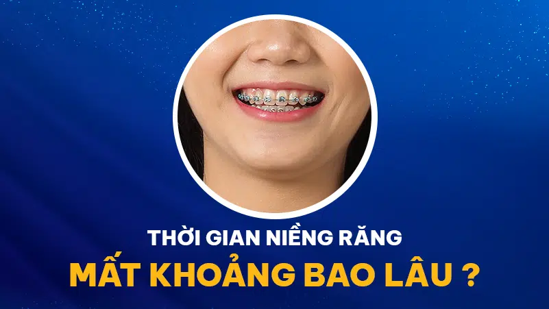 Niềng Răng Mắc Cài Khoảng Bao Lâu