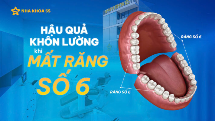 Hậu quả mất răng số 6
