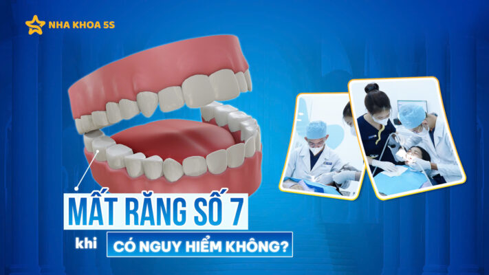 mất răng số 7 có nguy