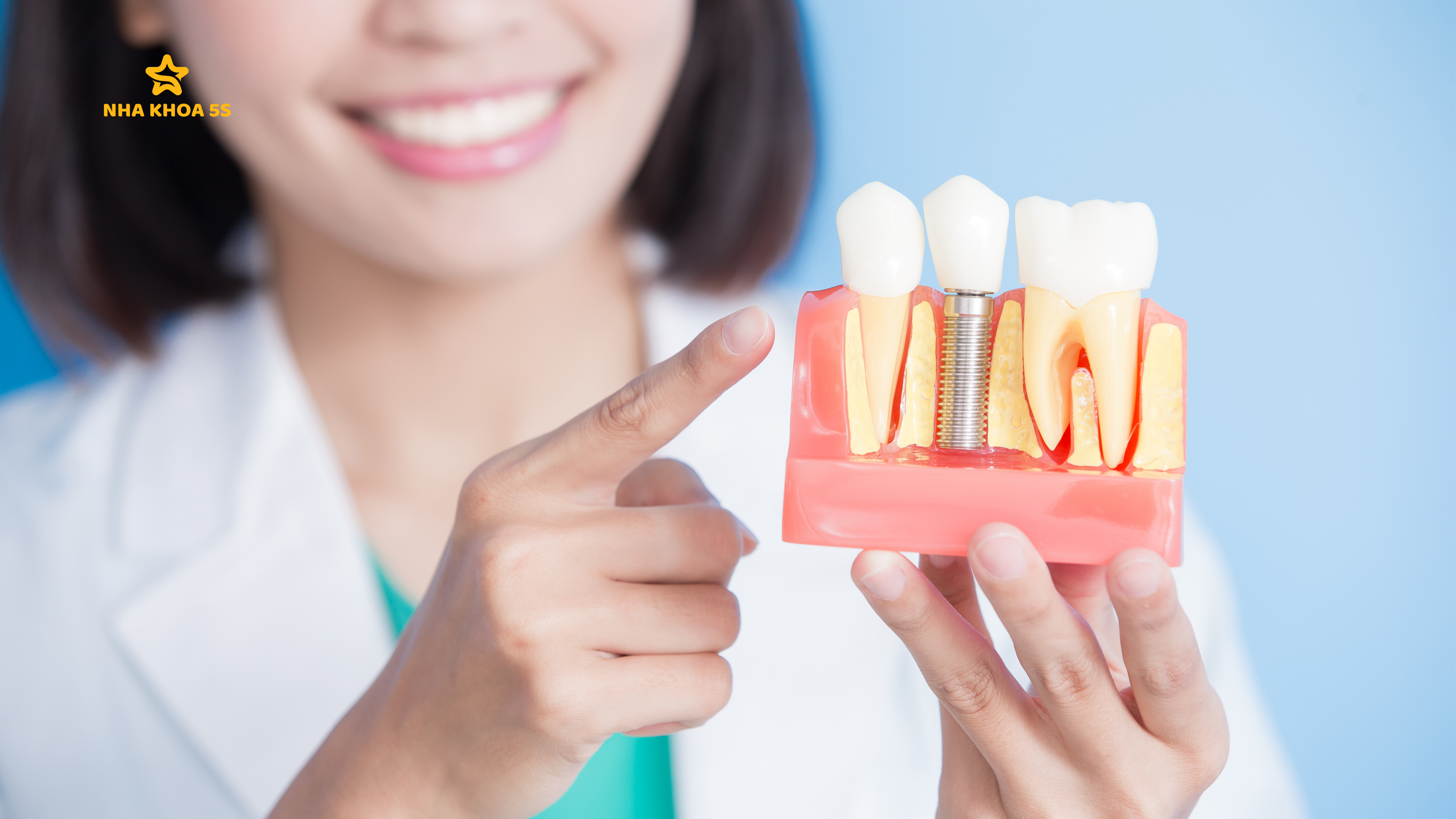 GIÁ IMPLANT MỸ THO: VÌ SAO NÊN CHỌN ĐẦU TƯ CHO NỤ CƯỜI BỀN VỮNG?
