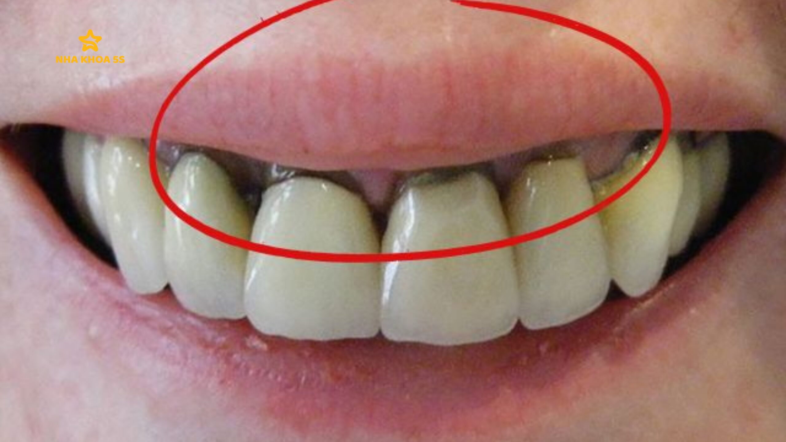 TẤT TẦN TẬT VỀ BỌC RĂNG SỨ MỸ THO: CHI PHÍ, ĐỘ BỀN, ƯU NHƯỢC ĐIỂM