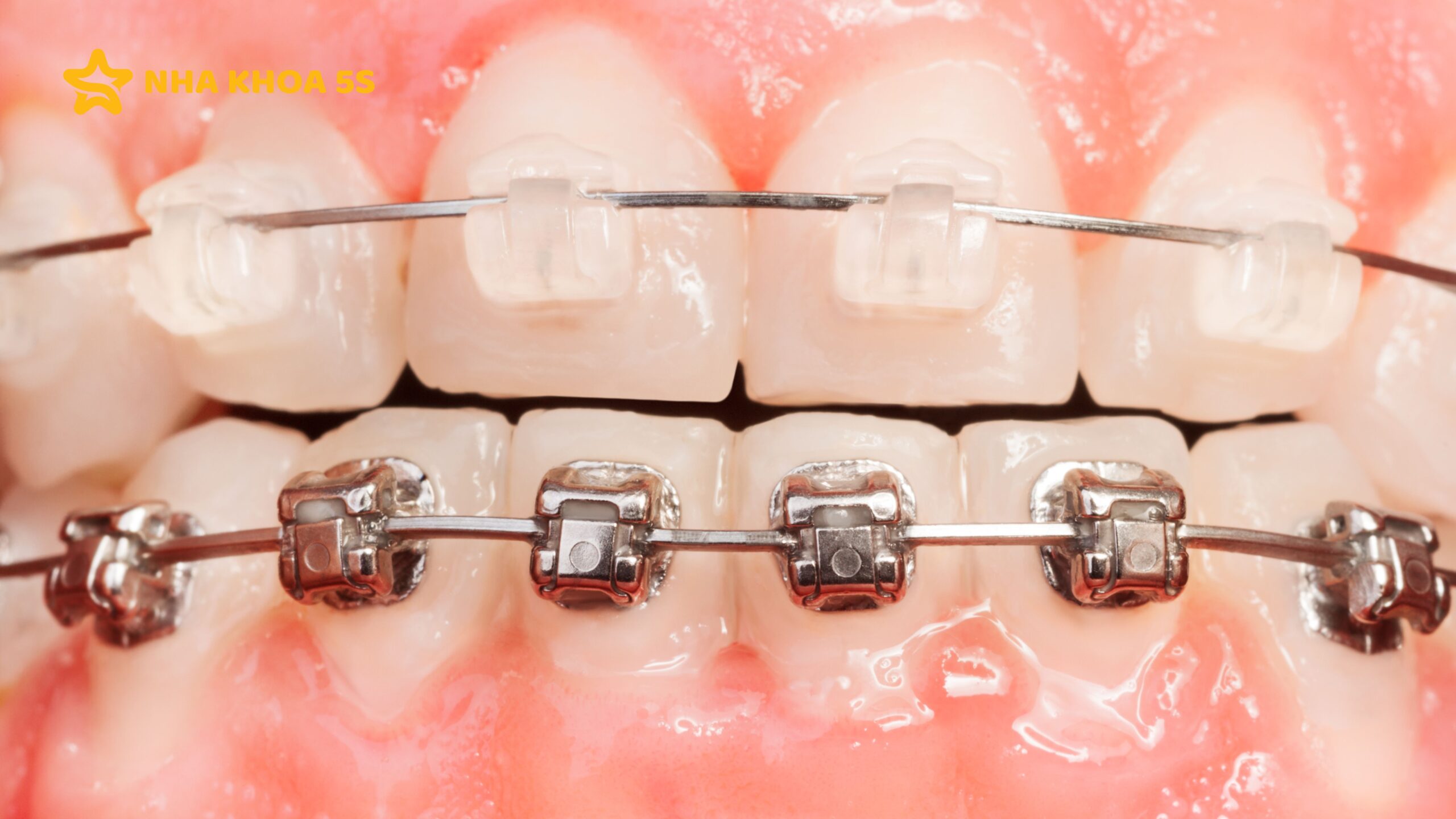 NIỀNG RĂNG MẮC CÀI MỸ THO: PHÂN LOẠI, ƯU – NHƯỢC ĐIỂM CẦN BIẾT