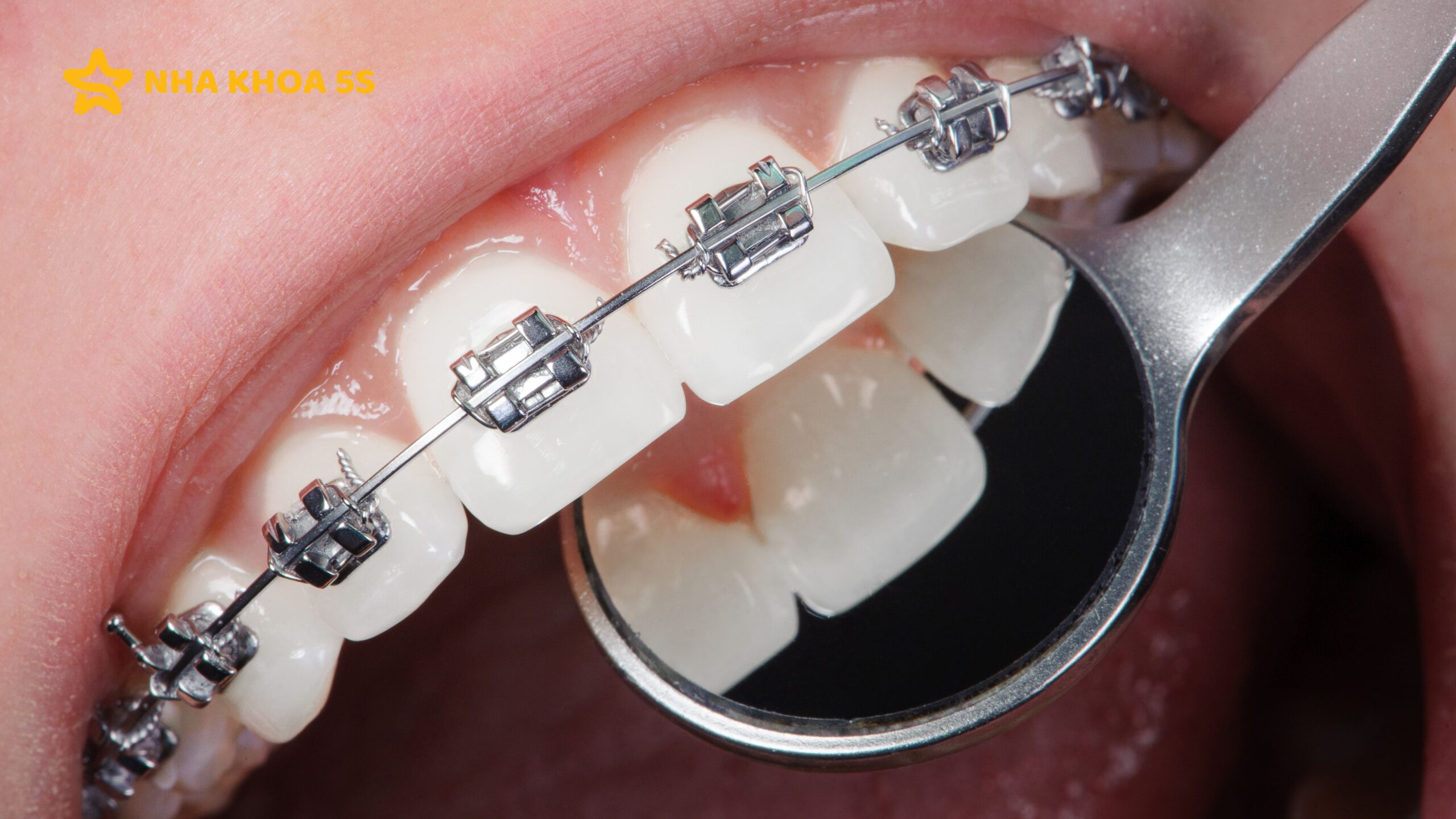 GIÁ NIỀNG RĂNG TRONG SUỐT 2025 – SO SÁNH CHI TIẾT VỚI NIỀNG RĂNG MẮC CÀI