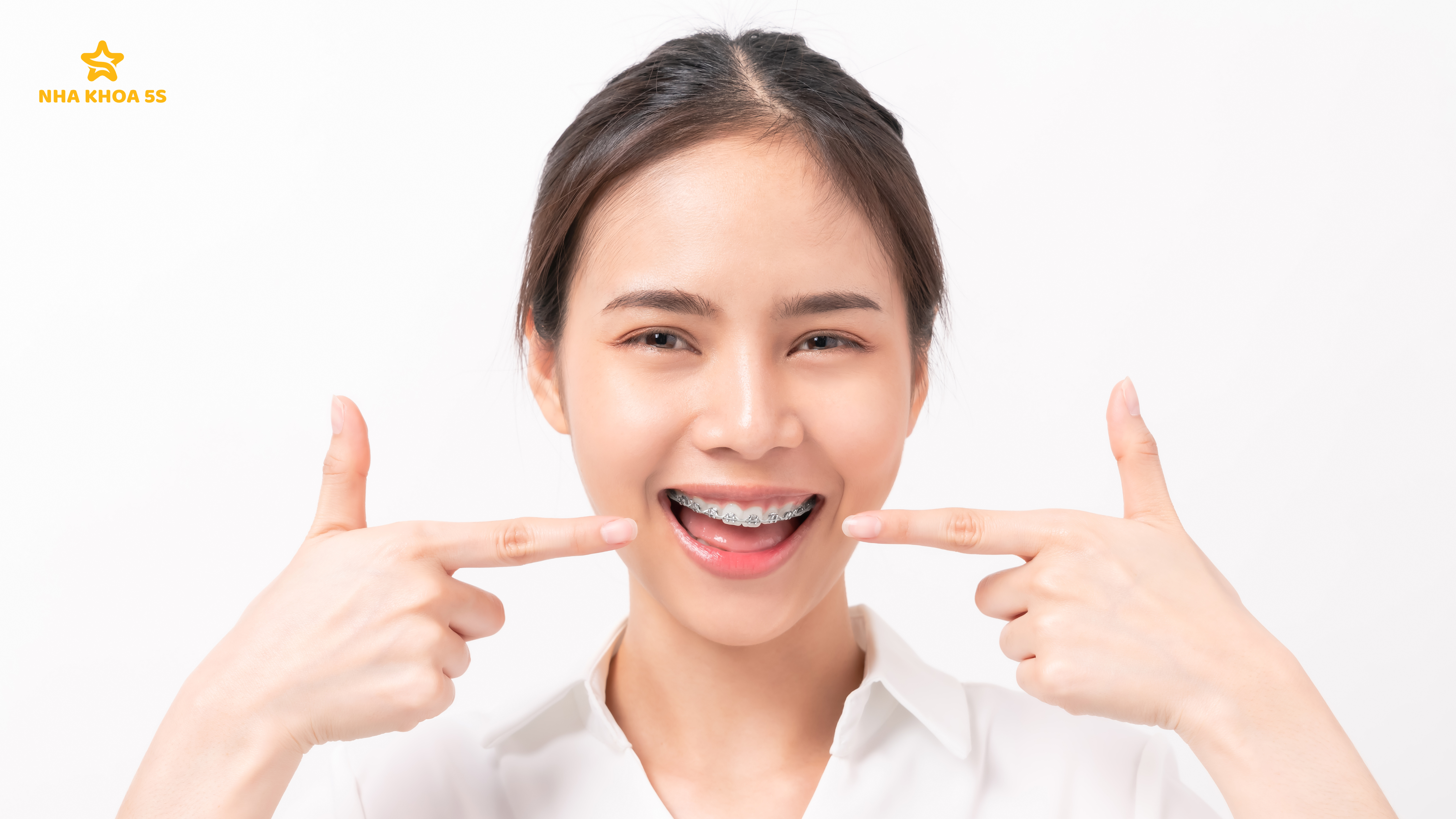 GIÁ NIỀNG RĂNG MẮC CÀI – GIẢI ĐÁP 10 CÂU HỎI THƯỜNG GẶP