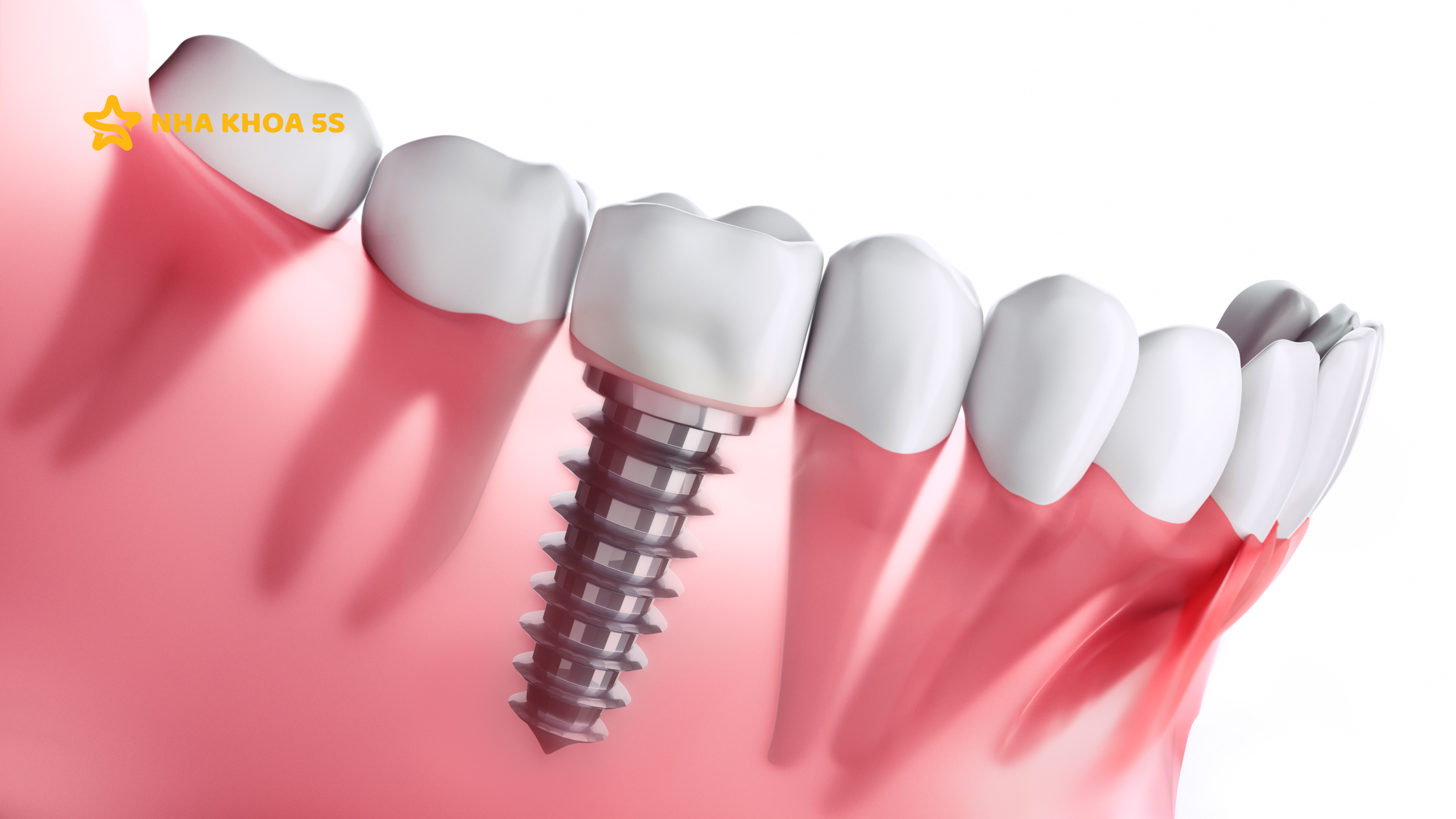 CẤY GHÉP IMPLANT MỸ THO - TRẢI NGHIỆM THỰC TẾ TỪ KHÁCH HÀNG 5S CẤY GHÉP IMPLANT MỸ THO – TRẢI NGHIỆM THỰC TẾ TỪ KHÁCH HÀNG 5S