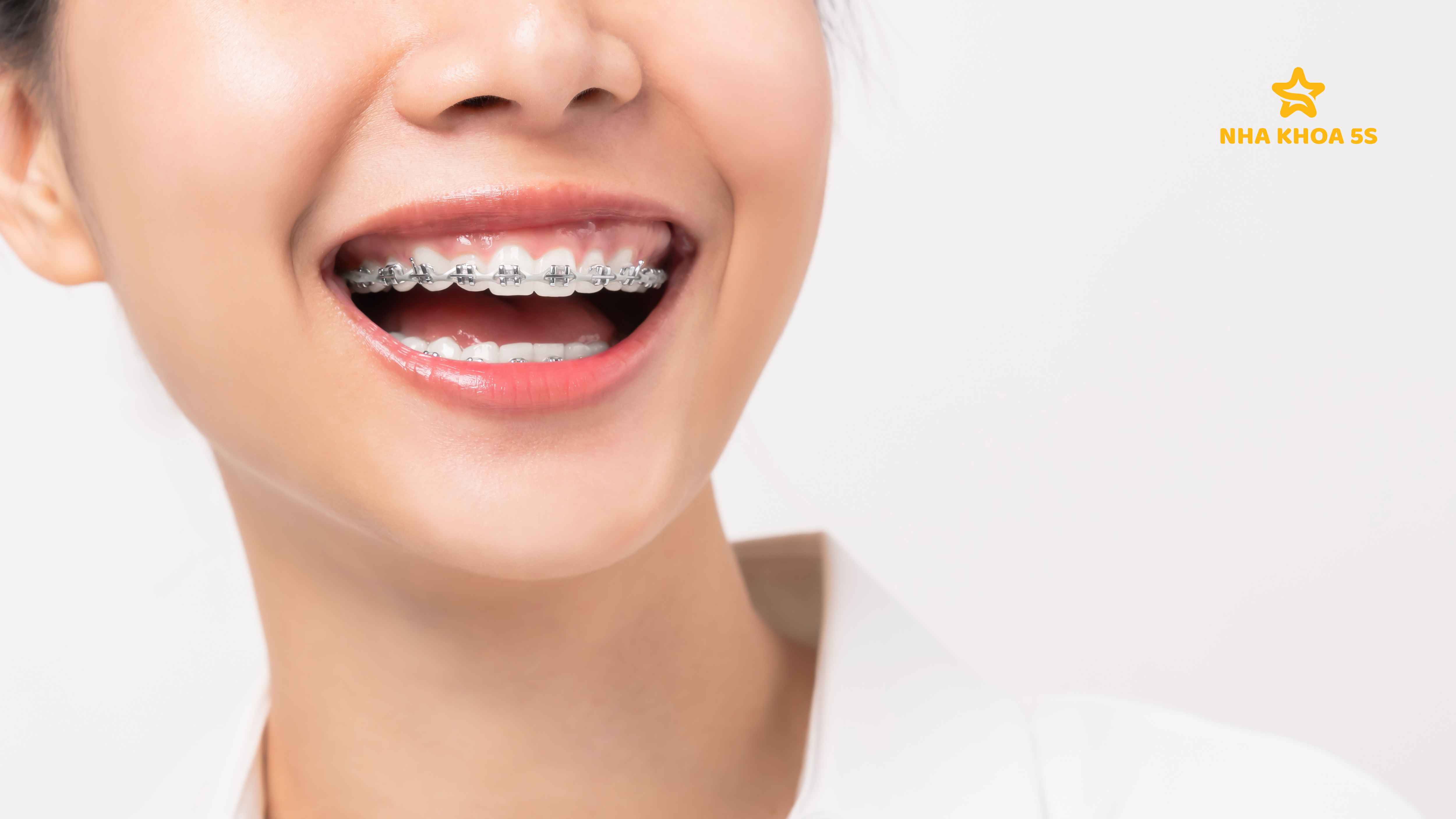 GIÁ NIỀNG RĂNG MẮC CÀI – GIẢI ĐÁP 10 CÂU HỎI THƯỜNG GẶP
