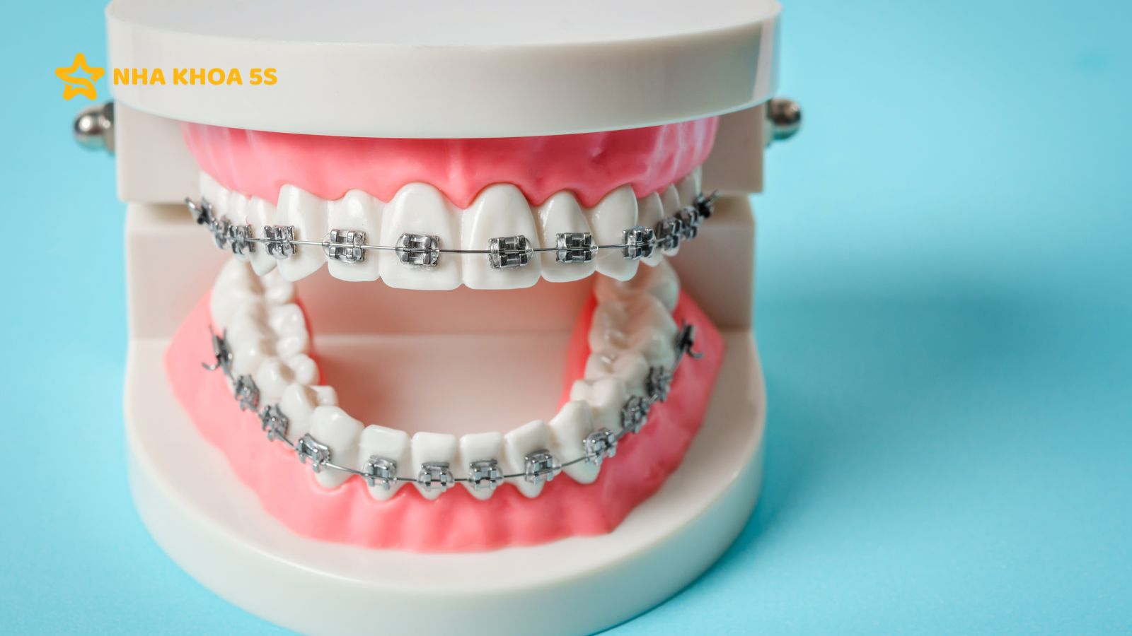 NIỀNG RĂNG TRẢ GÓP: GIẢI PHÁP TÀI CHÍNH LINH HOẠT