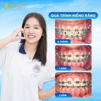 Niềng Răng Không Mắc Cài Giá Bao Nhiêu Tiền? Bảng Chi Phí Mới Nhất &Amp;Amp; Những Điều Cần Biết Trước Khi Quyết Định