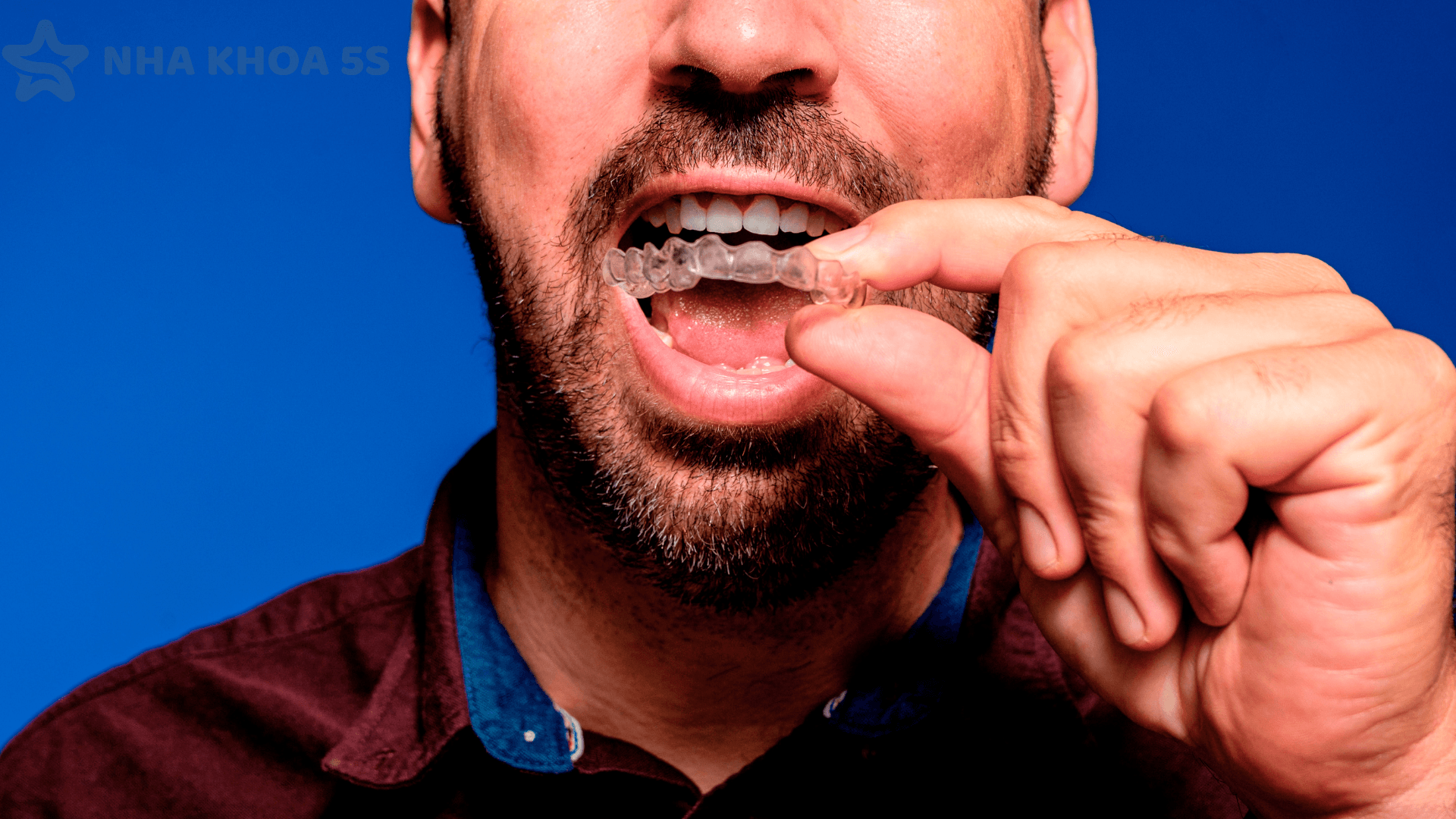 Niềng Răng Invisalign Gò Vấp – Giải Pháp Chỉnh Nha Thẩm Mỹ Hiện Đại