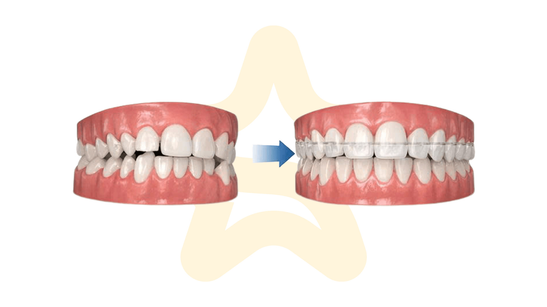 Niềng Răng Invisalign Trả Góp – Giải Pháp Chỉnh Nha Hiện Đại Tại Nha Khoa 5S