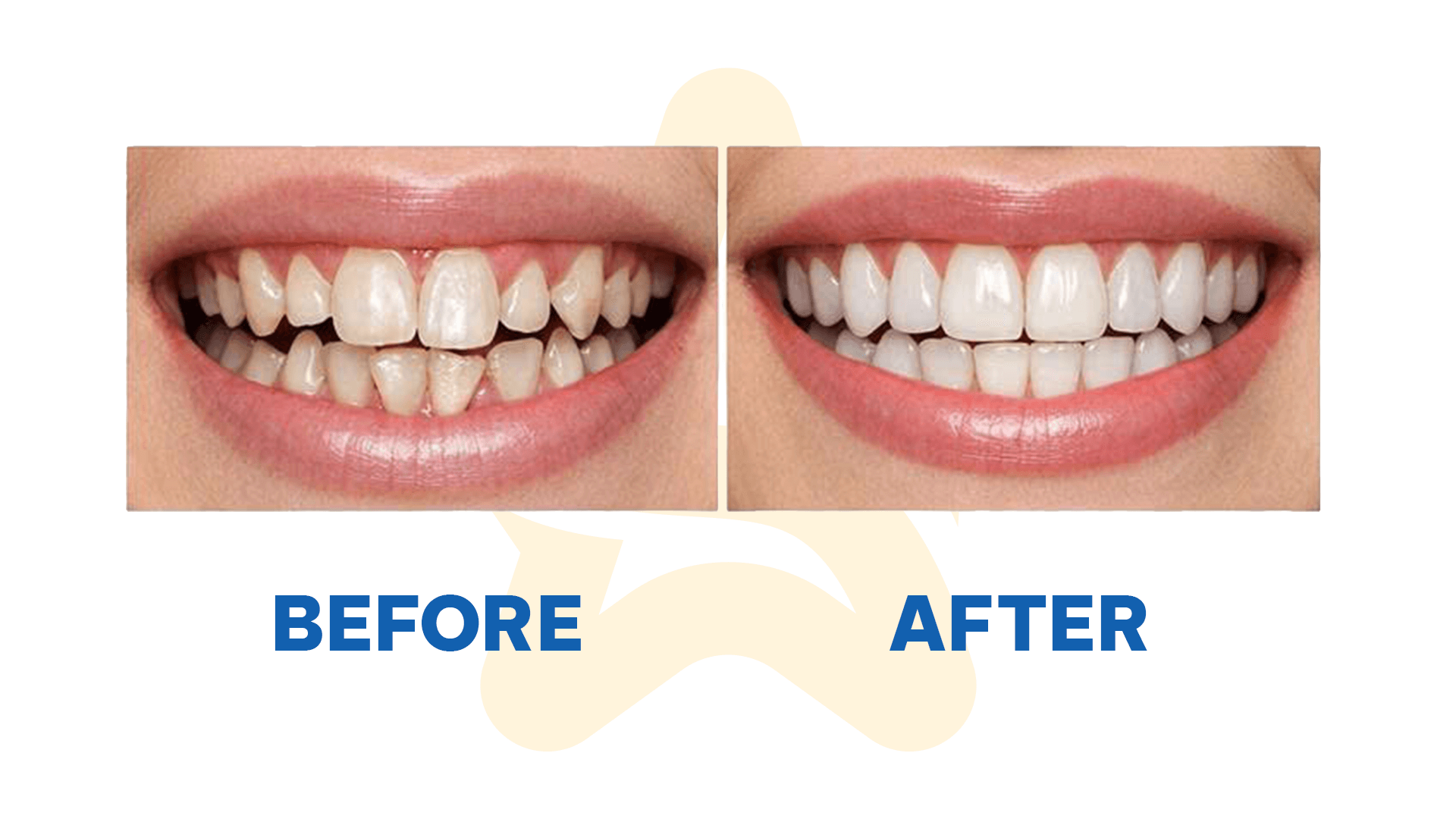 Niềng Răng Invisalign Trả Góp – Giải Pháp Chỉnh Nha Hiện Đại Tại Nha Khoa 5S