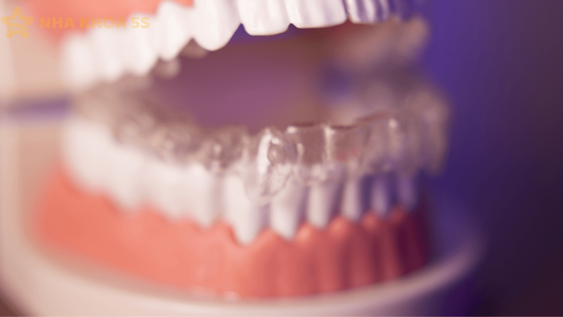 Nhược Điểm Niềng Invisalign: Sự Thật Cần Biết Trước Khi Lựa Chọn Năm 2026